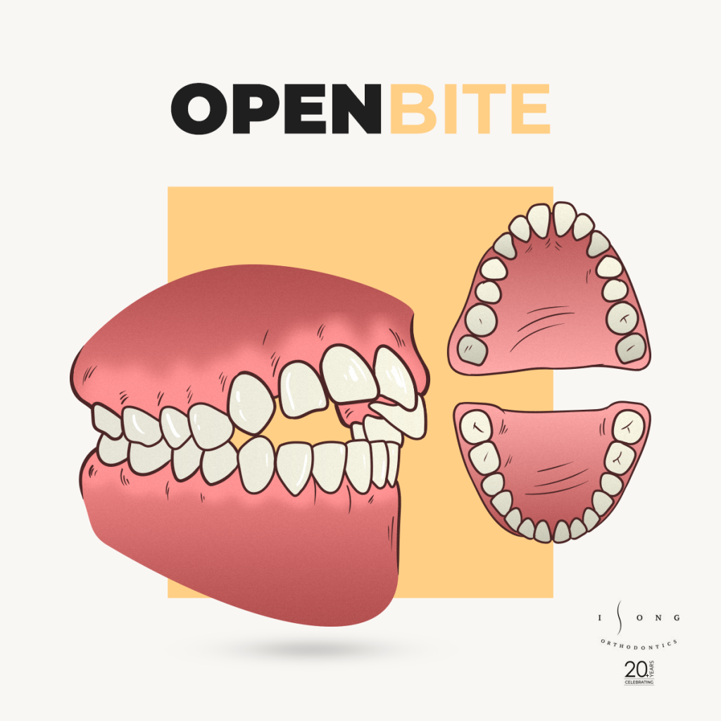 Fix an open bite with braces